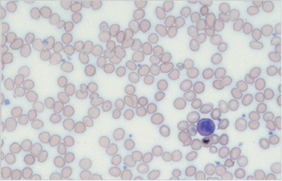 부적합 슬라이드 혈구 이미지3